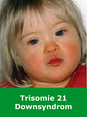 Trisomie 21, Downsyndrom